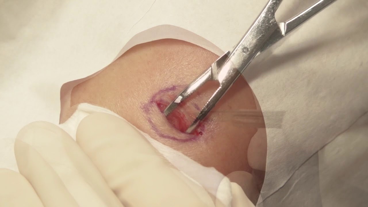 Lipoma excision surgery